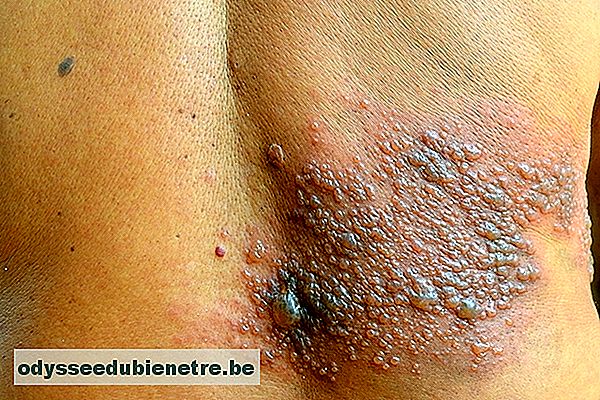 O que é e como tratar a dermatite herpetiforme