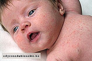 Alergia na pele do bebê