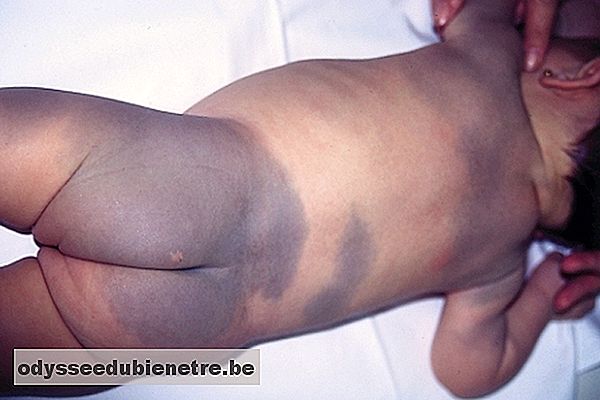 Manchas azuladas ou arroxeadas na pele do bebê não precisam de Tratamento