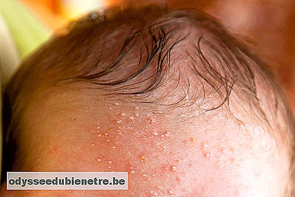 Problemas de pele mais comuns no bebê