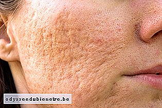 Tratamento com ácido mandélico para cicatriz de Acne