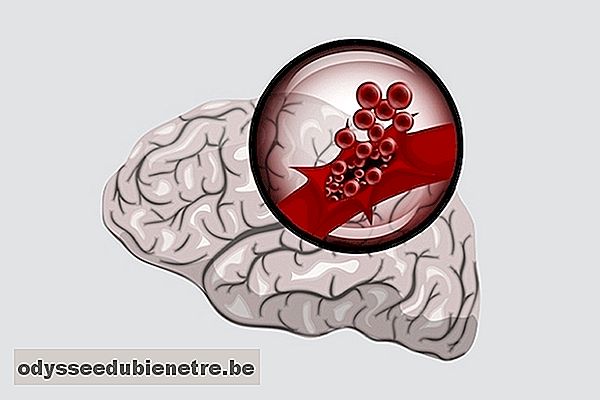 Hemorragia cerebral: sintomas, causas e possíveis sequelas