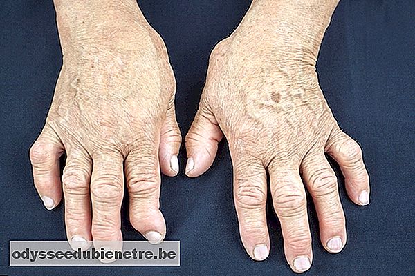 Artrite pode ser causada pela Psoríase