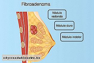 Sintomas de fibroadenoma da mama