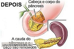 Cirurgia para o câncer de pâncreas