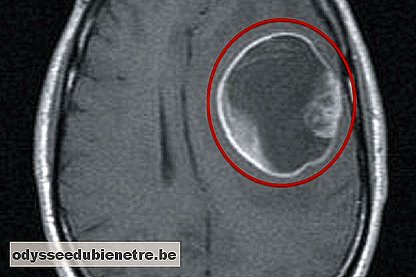 Ressonância magnética de um tumor cerebral no lobo parietal
