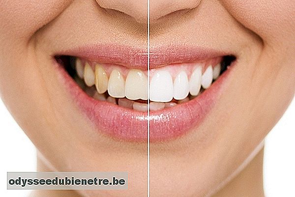 Antes e depois do clareamento dental