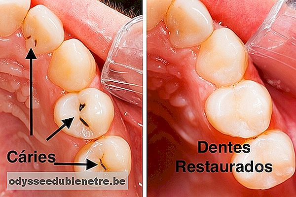 Como identificar e tratar a Cárie Dentária
