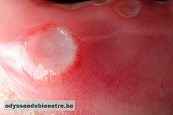 O que pode causar dor na língua