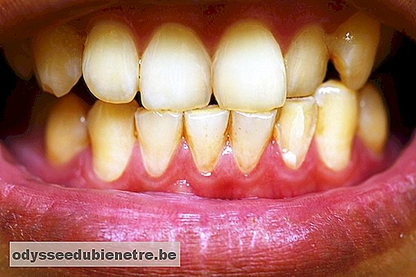 Placa bacteriana nos dentes