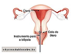 Como é feita a biópsia ao colo do útero