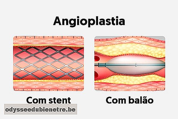 O que é a Angioplastia e como é feita