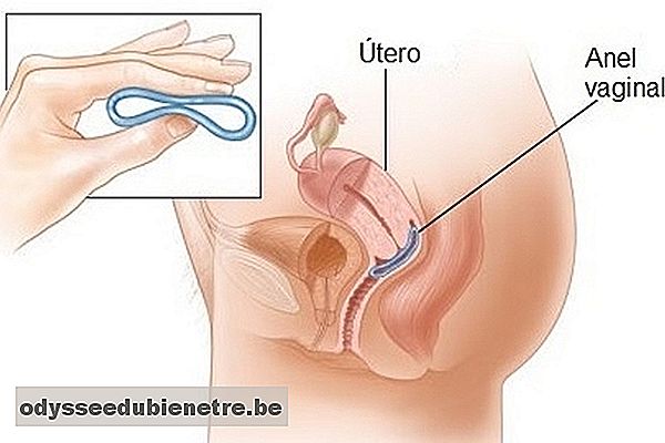 9 dúvidas mais comuns sobre o uso do anel vaginal