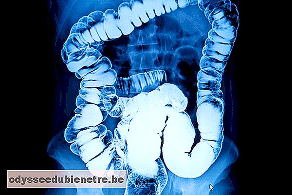O que é o volvo intestinal e como identificar