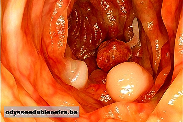 Presença de pólipos no intestino