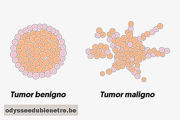 Qual a diferença entre tumor, câncer e neoplasia