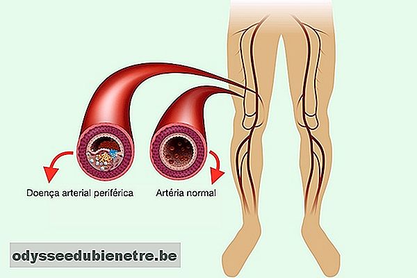 O que é Doença Arterial Periférica e como identificar