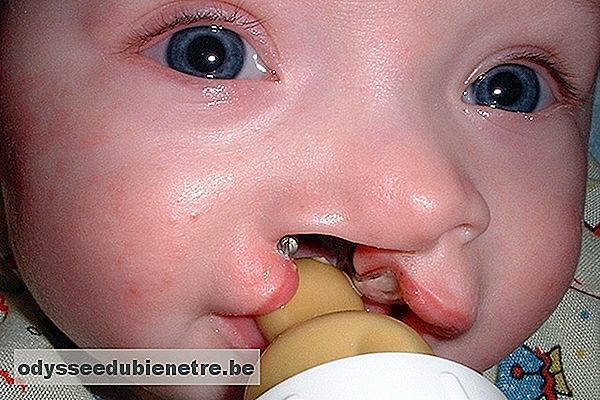 Foto de um bebê com Síndrome de Patau