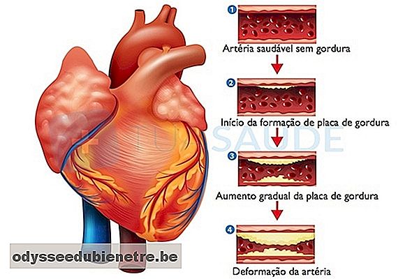 Formação de placas de ateroma e calcificação da aorta