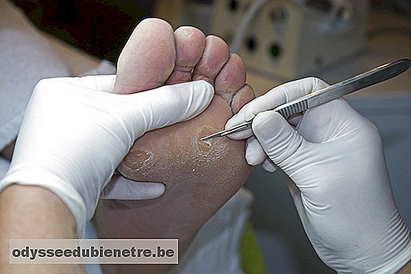 Podologista removendo um calo do pé no consultório