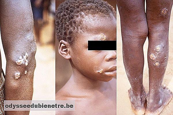 Doença de pele Bouba - Como identificar e Tratar