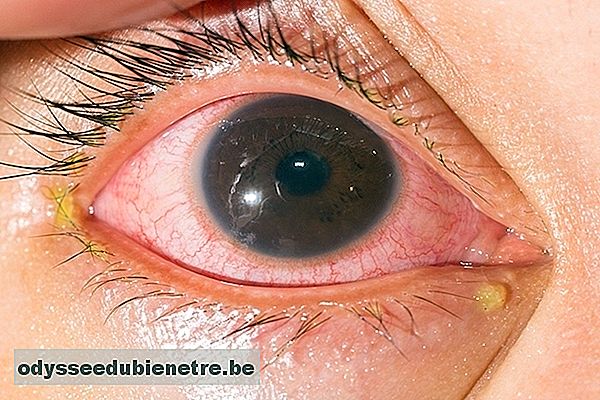 Tracoma - Conjuntivite causada pela Clamídia