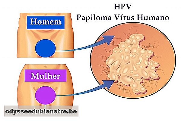 Tratamento do HPV - Remédios e Cirurgia