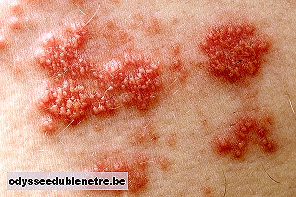 El herpes zóster causa lesiones y ampollas en la piel..