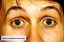Olhos e pele amarela