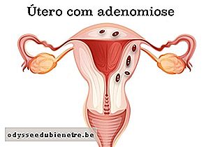 Tecido dentro do músculo do útero com adenomiose