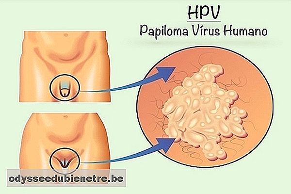 HPV: sintomas, transmissão, cura e tratamento