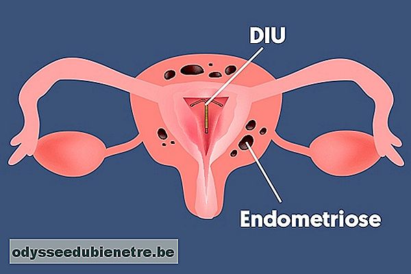 DIU Mirena combate a Endometriose