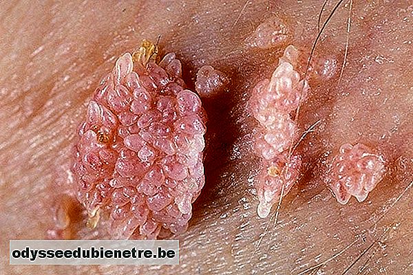 Verruga com crista - HPV