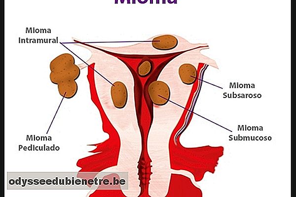 Tipos de mioma uterino