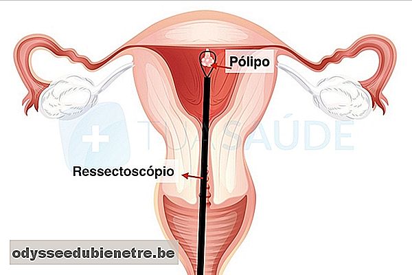 Como é feita a cirurgia para retirar o pólipo uterino.