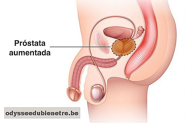 Hiperplasia benigna da próstata