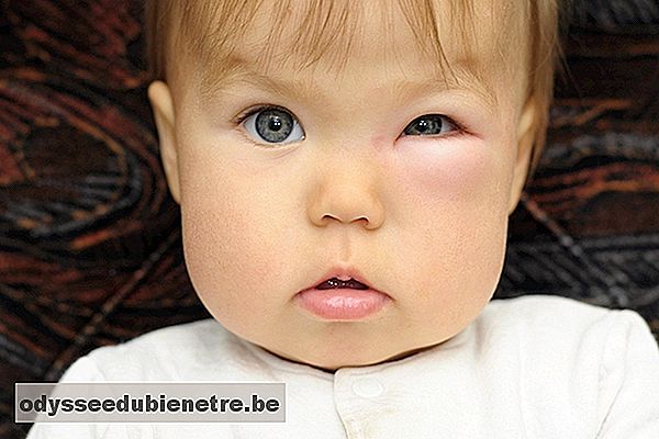 Celulite no olho: Remédio e risco de contágio
