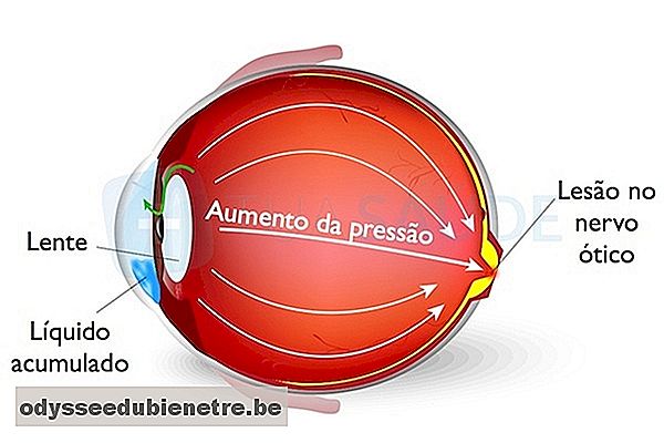Olho com aumento da pressão ocular
