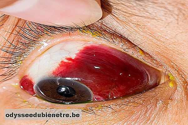 O que pode ser a vermelhidão nos olhos e como tratar