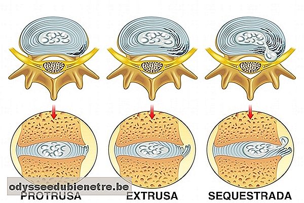 Tipos de hérnia de disco