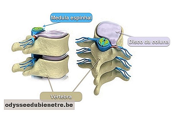 Hérnia de disco protrusa póstero-lateral