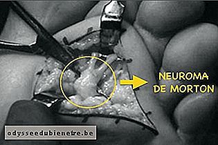 Cirurgia para Neuroma de Morton