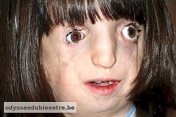 Treacher Collins: a síndrome que deixa o rosto deformado