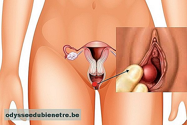 Caroço na vagina pode ser Cisto de Gartner
