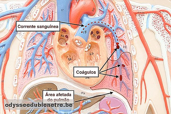 Entenda o que é a embolia pulmonar