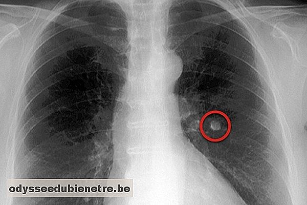 Raio X com nódulo no pulmão
