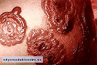 Dermatite Bolhosa Distrófica