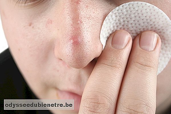Como limpar a pele com acne