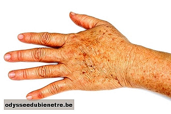 Como tirar os 7 tipos mais comuns de manchas escuras na pele 