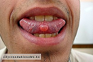 Mucocele debaixo da língua